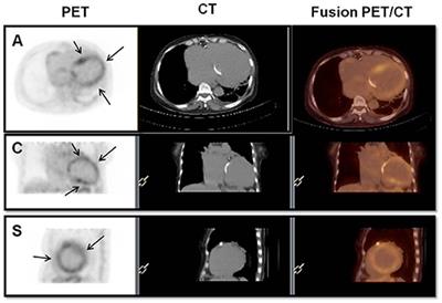 Rheumatic Myocarditis: A Poorly Recognized Etiology of Left Ventricular Dysfunction in Valvular Heart Disease Patients